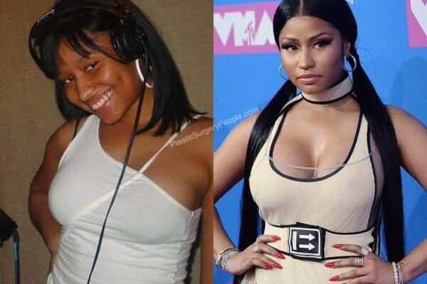 Did Nicki Minaj have boob job?
