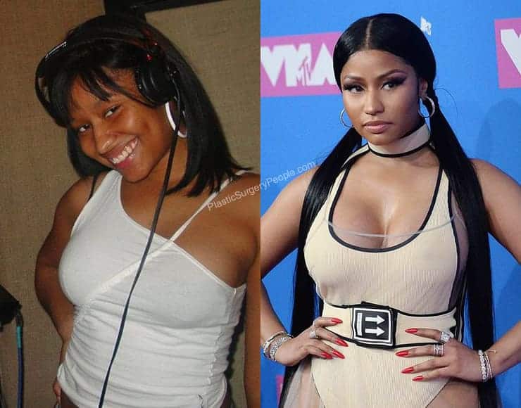 Did Nicki Minaj have boob job?
