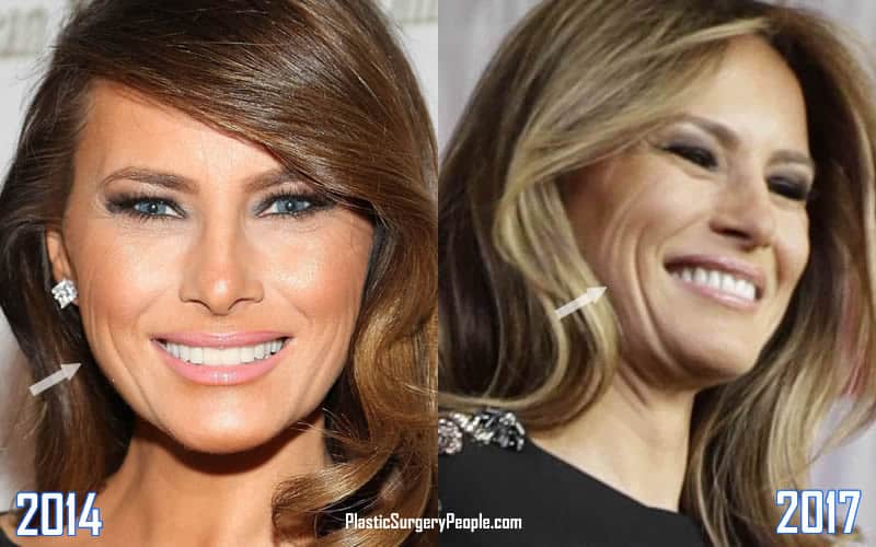 Melania's face wrinkles are quite visible