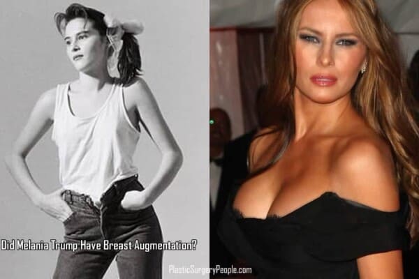 Did Melania Trump Have Plastic Surgery Before She Became FLOTUS?