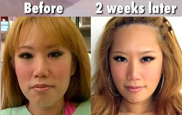 Xiaxue Botox Before & After