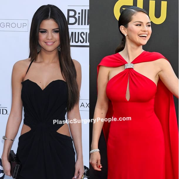 Selena Gomez boob job before and after photo