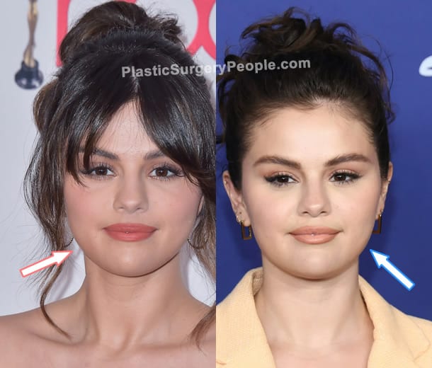 Selena Gomez botox before and after photo