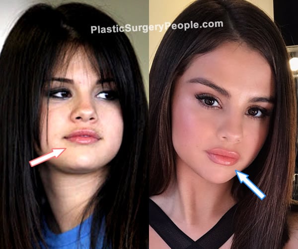 Selena Gomez lip fillers before and after photo