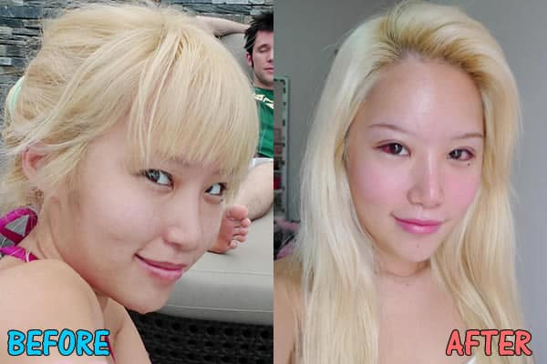 Xiaxue's eye surgery before and after