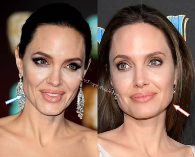 Angelina Jolie botox and facelift - Before and After