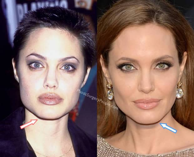 Angelina Jolie chin implant before and after