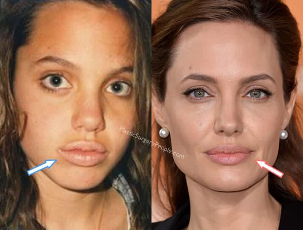 Angelina Jolie lip injections before and after