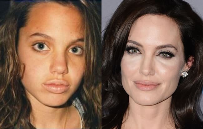 Angelina Jolie Plastic Surgery