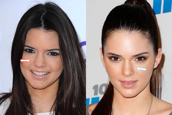 Kendall's nose before and after nose job?