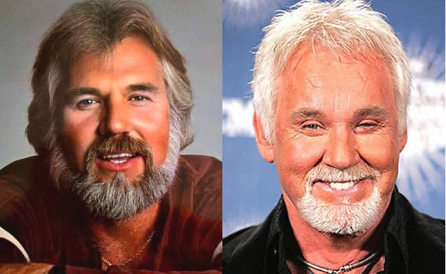 Kenny Roger Plastic Surgery Before and After