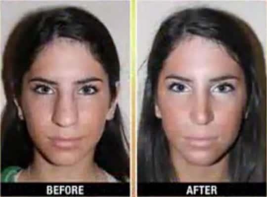 Jen Selter Nose Job Before & After - Front View