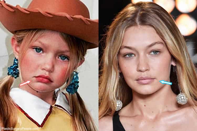 Gigi Hadid's Lips Before and After