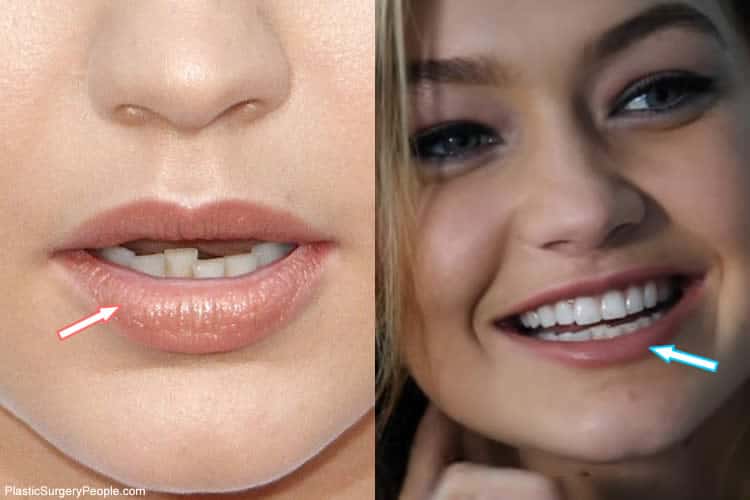 Gigi Hadid's Teeth