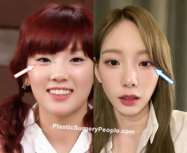 Taeyeon double eyelid surgery before and after photo