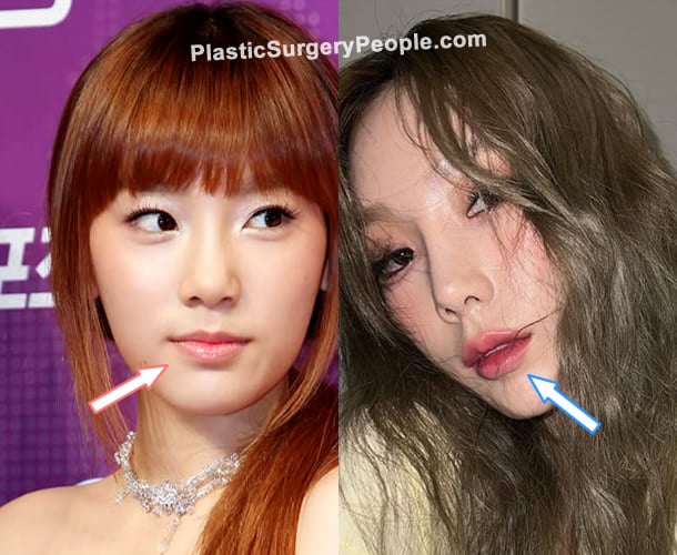 Taeyeon lip injections before and after photo