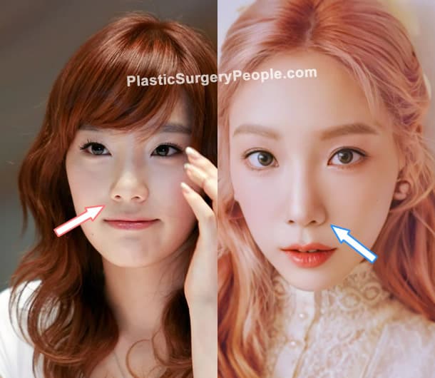Taeyeon nose job before and after photo