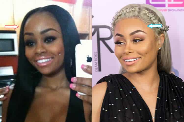 Blac Chyna Forehead before and after photo