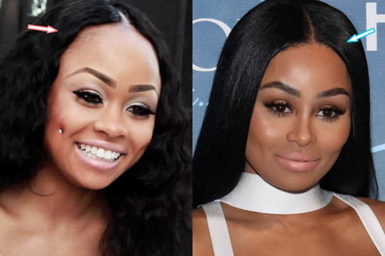 Blac Chyna hair transplant before and after photo