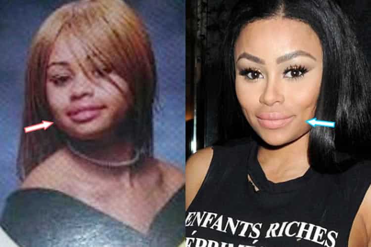 Blac Chyna lip injections before and after photo