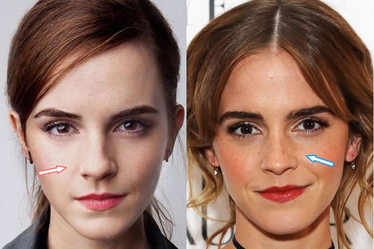 Has Emma Watson Had a Nose Job?