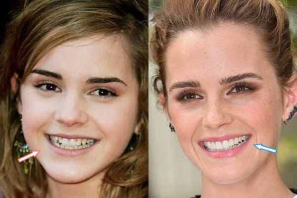 Emma Watson Cosmetic Surgery – Nose Job, Teeth & Breast Implants?