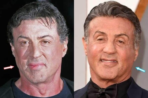 Sylvester Stallone's face before facelift and botox?