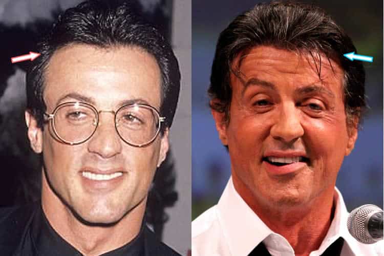 Sylvester Stallone hair before and after