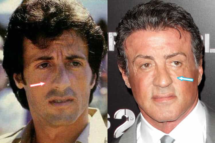 Has Sylvester Stallone has a nose job?