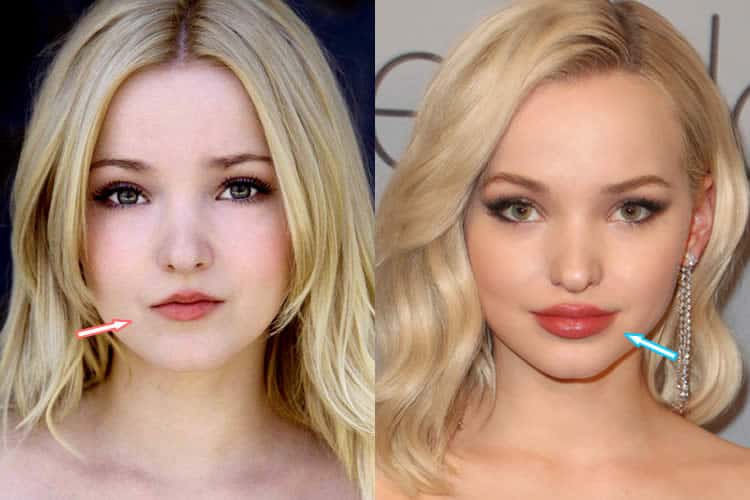 Did Dove Cameron Get Lip Injections?