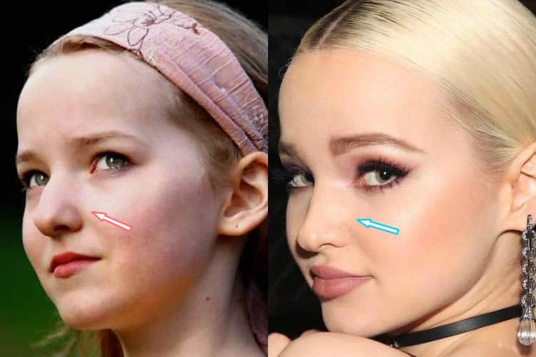 Did Dove Cameron Have A Nose Job?