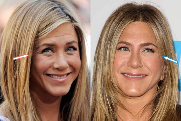 Does Jennifer Aniston Use Botox?