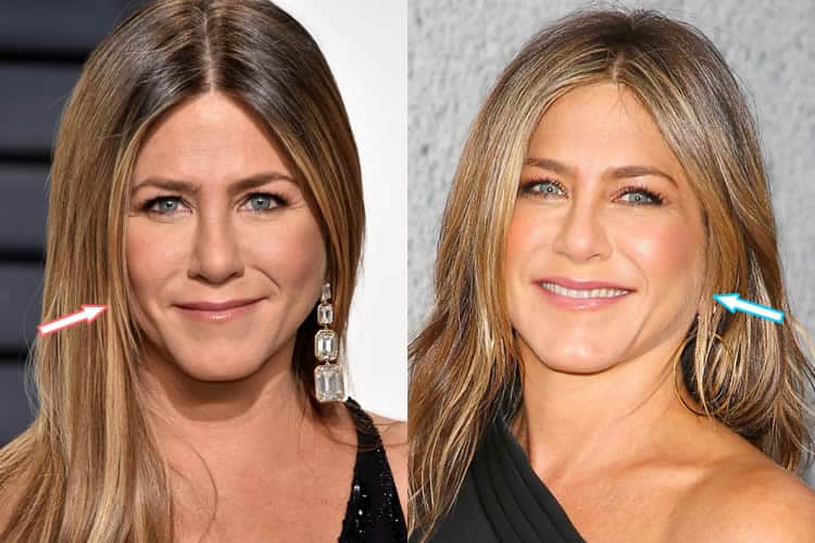 Did Jennifer Aniston Have A Facelift?