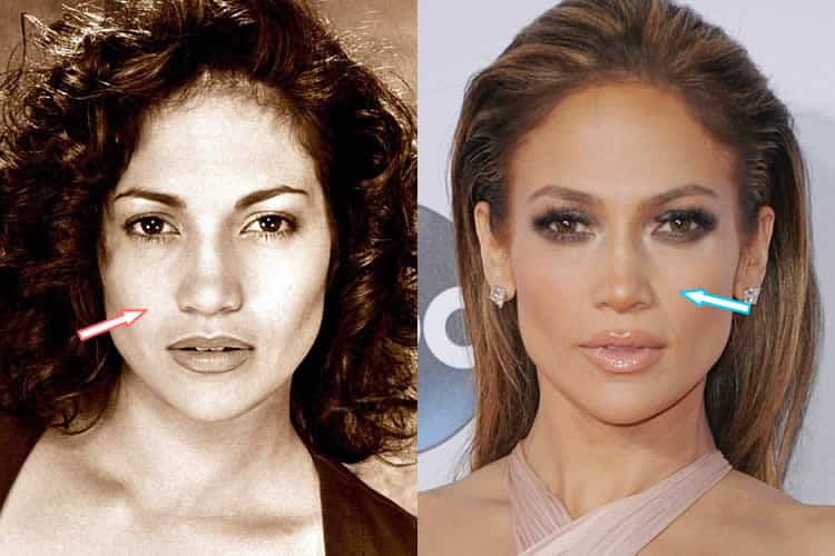Did Jennifer Lopez Have A Nose Job?
