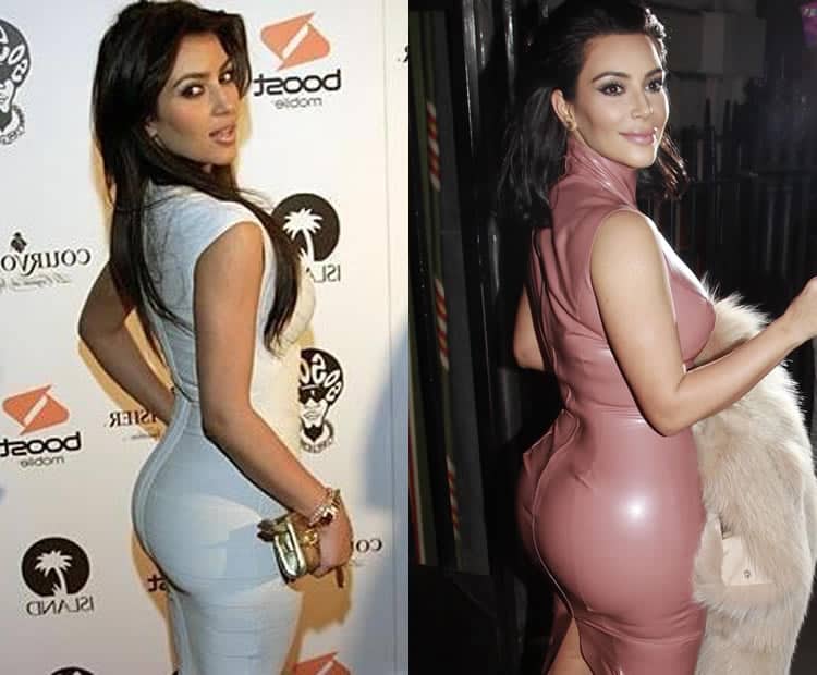 Does Kim Kardashian Have Butt Implants?