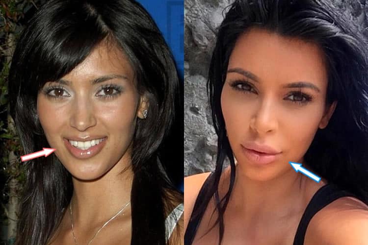 Does Kim Kardashian Have Lip Injections?