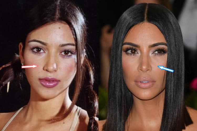 Did Kim Kardashian Have A Nose Job?