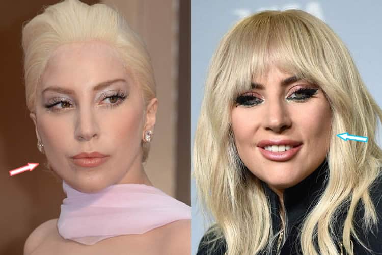 Has Lady Gaga Had Botox Injections?