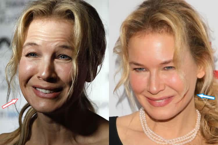 Has Renee Zellweger Had Botox Fillers?