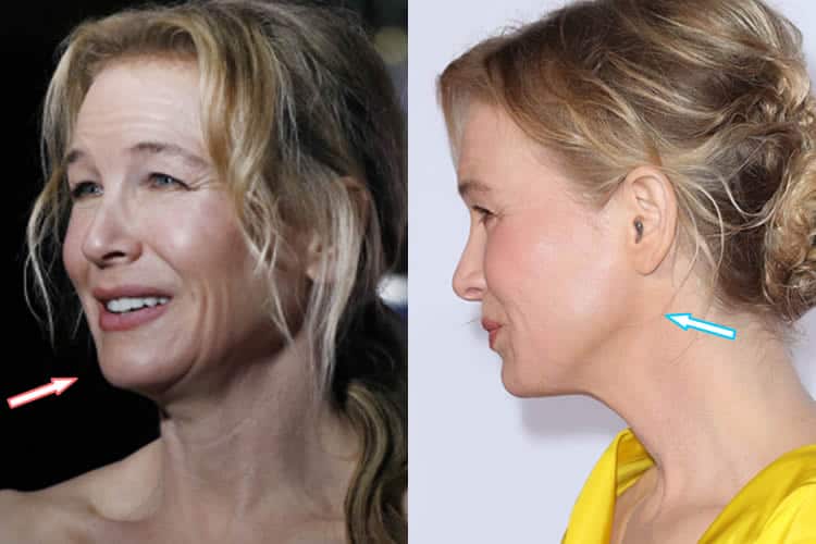 Did Renee Zellweger Have A Facelift?