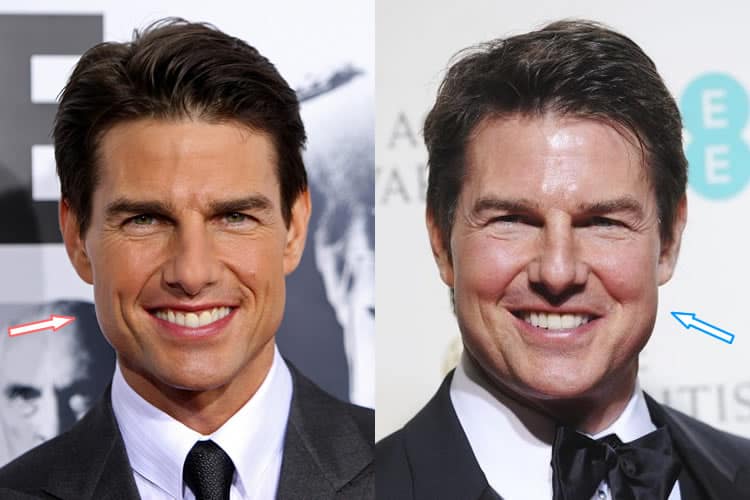 Did Tom Cruise Get Botox Injections?