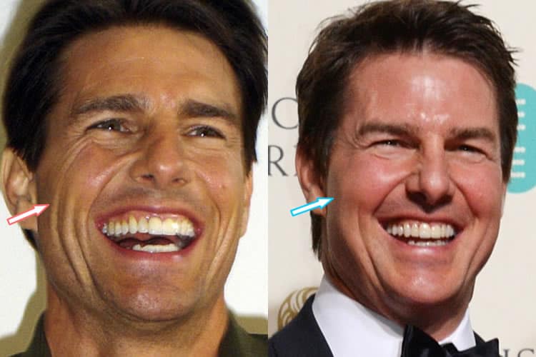 Has Tom Cruise Had A Facelift?