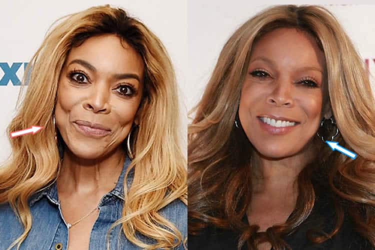 Did Wendy Williams Get A Facelift?