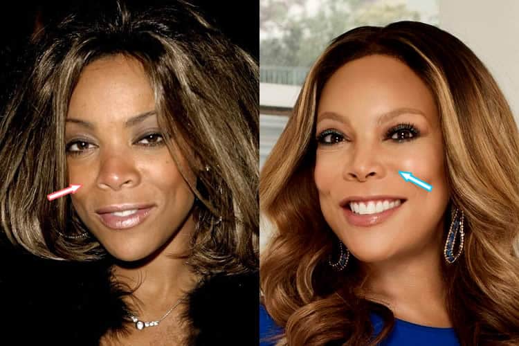 Did Wendy Williams Have A Nose Job?