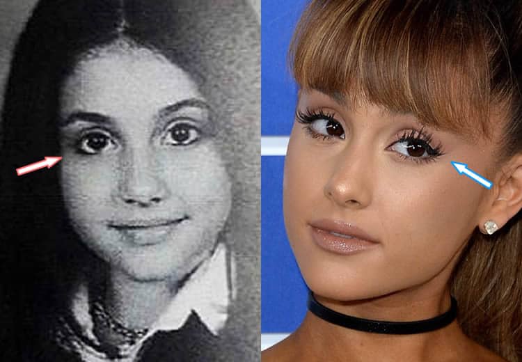 Did Ariana Have Eye Surgery?