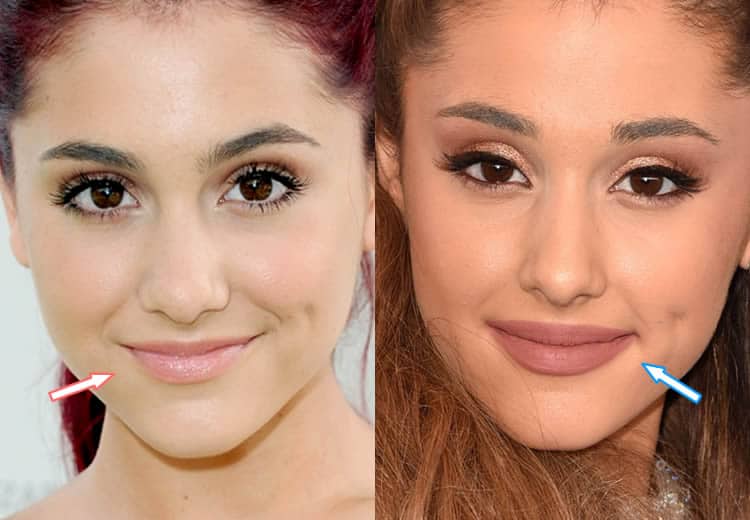Does Ariana Grande Have Lip Injections?