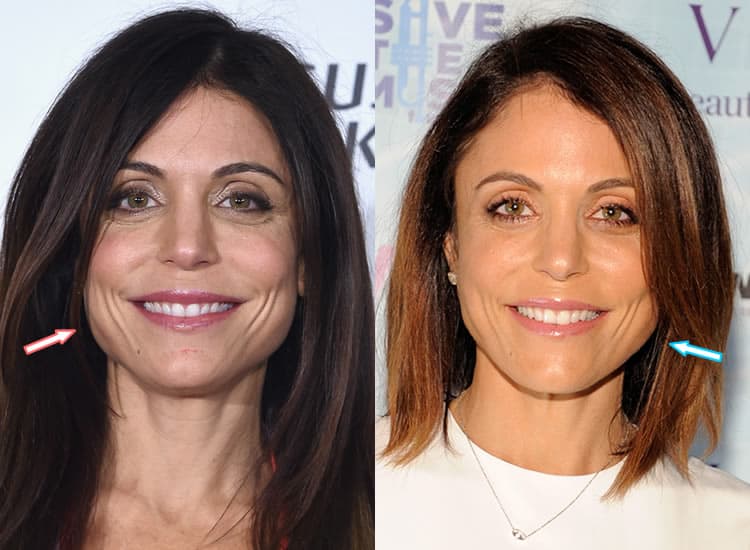 Did Bethenny Frankel Get Face Lift & Botox Injections?