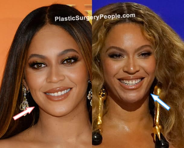 Beyonce botox before and after photo