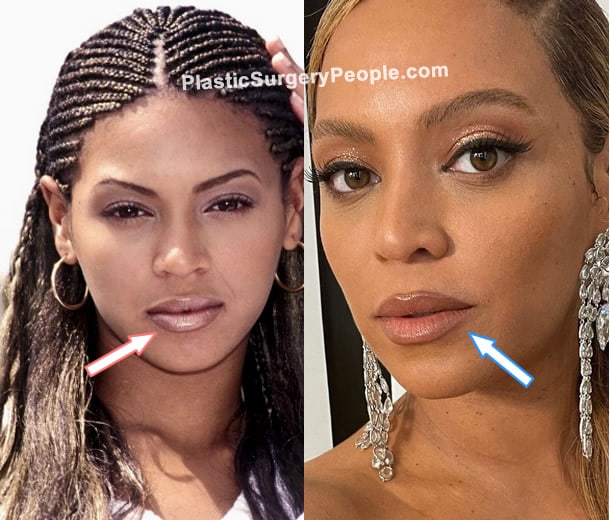 Beyonce lip fillers before and after photo