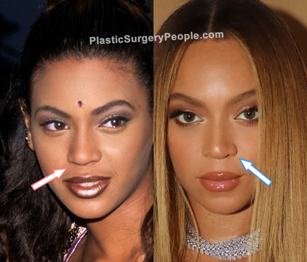 Beyonce nose job before and after photo
